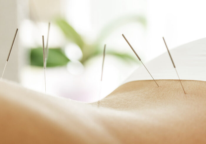 Reasons Why Acupuncture Is Considered The Best Treatment For Back Pain