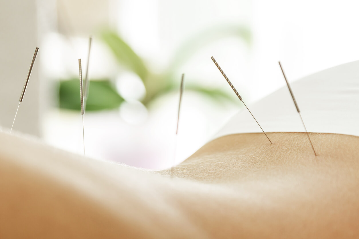 Reasons Why Acupuncture Is Considered The Best Treatment For Back Pain