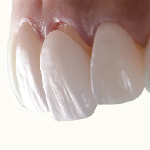 When Is The Right Time To Get Veneers?