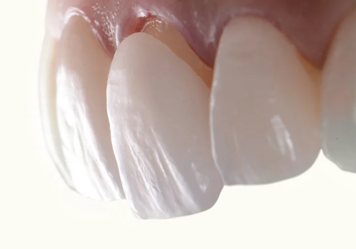 When Is The Right Time To Get Veneers?